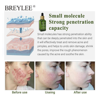 Anti Acne Gel Serum for Pimples & Acne Scars | BREYLEE (15ml)