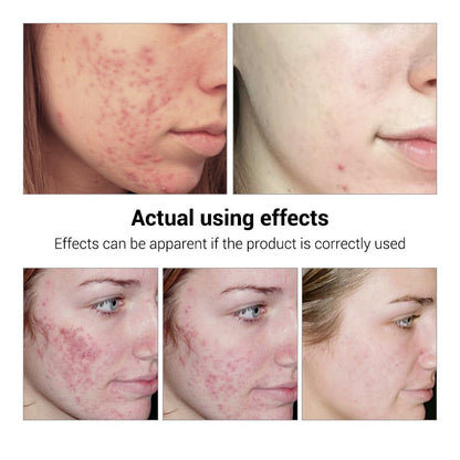 Anti Acne Gel Serum for Pimples & Acne Scars | BREYLEE (15ml)