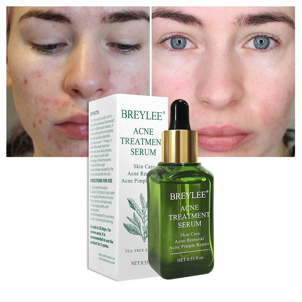 Anti Acne Gel Serum for Pimples & Acne Scars | BREYLEE (15ml)