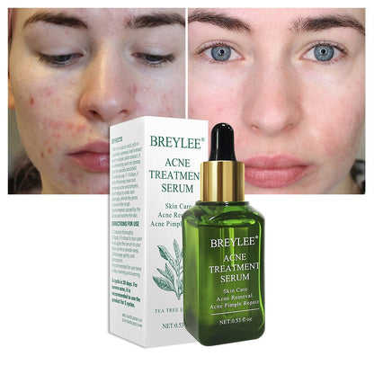 Anti Acne Gel Serum for Pimples & Acne Scars | BREYLEE (15ml)