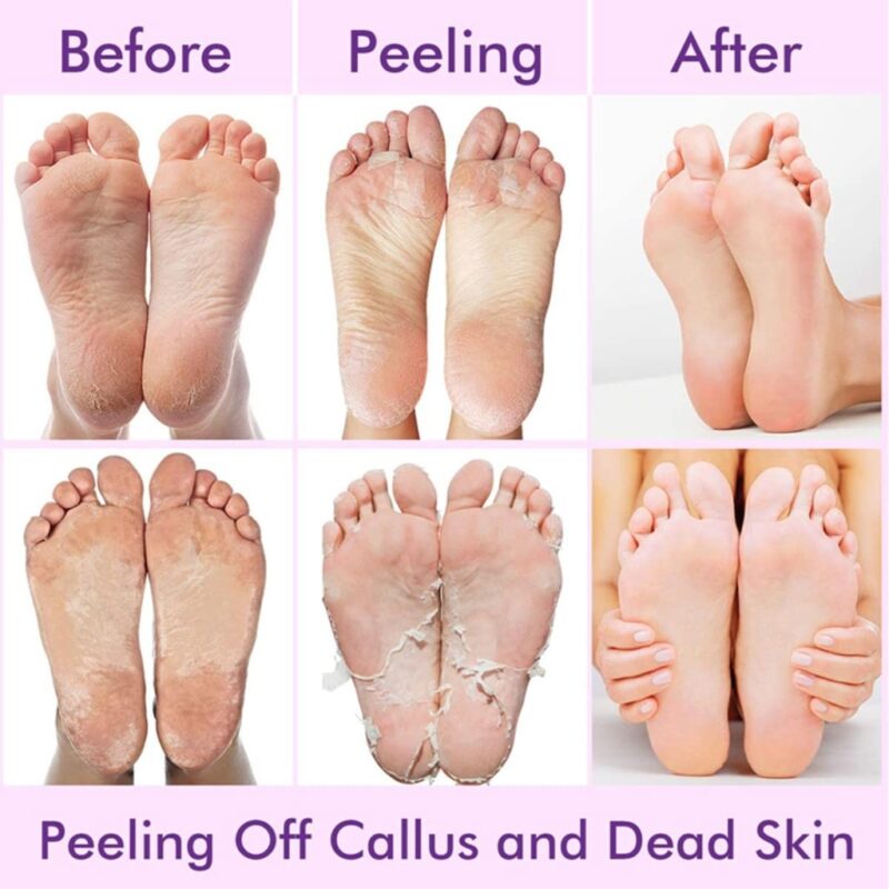 Before and after results of foot peel mask showing smooth soft feet